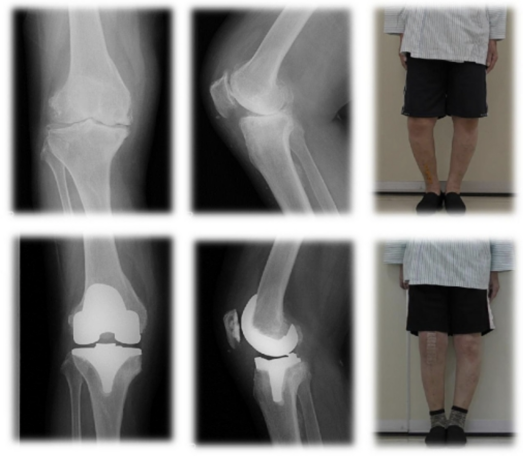 変形 性 膝 関節 症